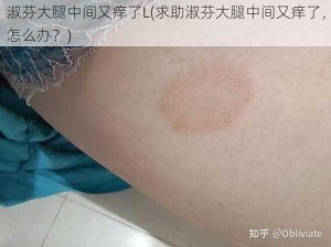 淑芬大腿中间又痒了L(求助淑芬大腿中间又痒了，怎么办？)